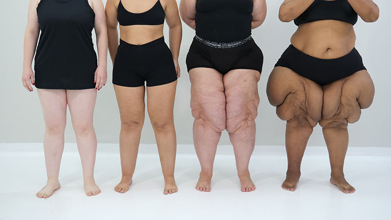 Lipedema: Compreendendo a Condição e o Papel da Nutrição no Tratamento